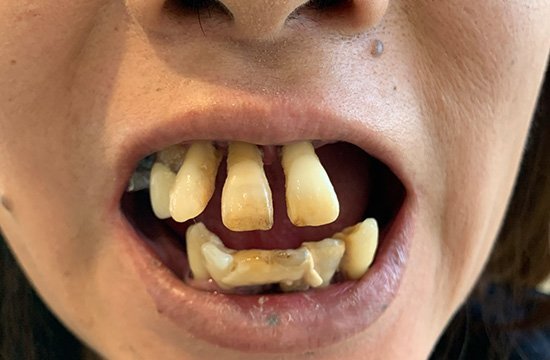 症例1 上下総義歯 施術前